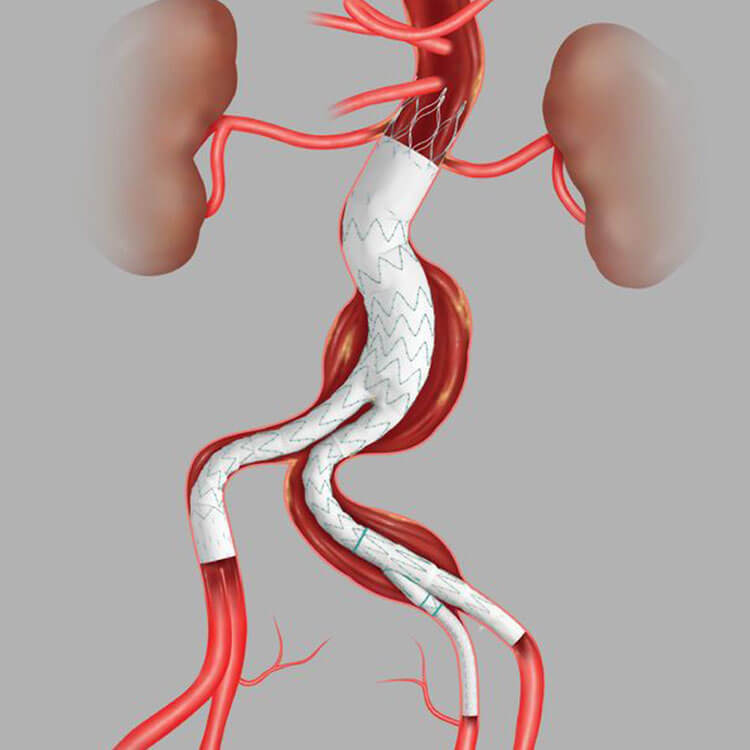 Cirurgia Vascular